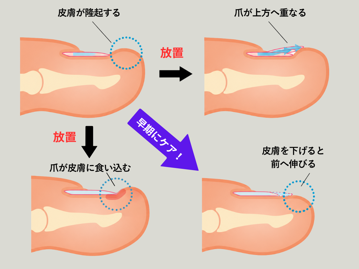 皮膚が隆起し爪が上方へ重なる仕組み